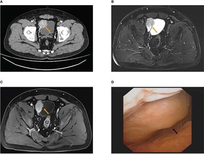 Case Report: Octreotide plus CVD chemotherapy for the treatment of multiple metastatic paragangliomas after double resection for functional bladder paraganglioma and urothelial papilloma